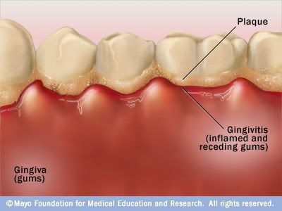dental care with diabetes