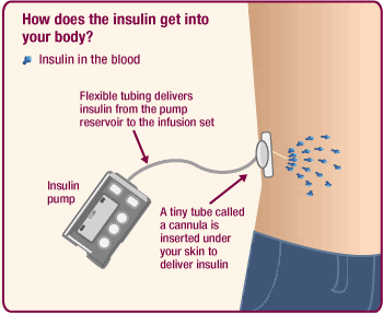 insulin pump